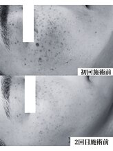 ソイ(Soi)/たった1回の変化です！