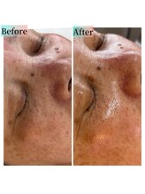 ミラビューティー(Mira Beauty)/60代ビフォーアフター