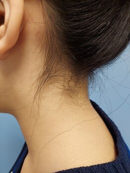 キアラ 麻布十番(Kiara)/うなじ脱毛ブラジリアンワックス