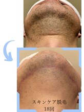 ミックスアップ 練馬店(Mix up)/「肌をキレイにする」脱毛効果