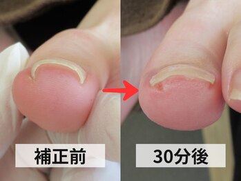 巻き爪ケア