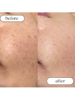 トータルビューティーサロンリア(Li'a)/ビフォー＆アフター