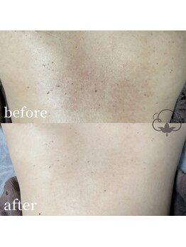 プライベートサロン コットン(COTTON)/ボディピーリング