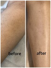 アジサイ(Ajisai)/結果重視の脱毛