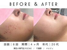 ロエヴェ(ROEWE)/ニキビ改善・毛穴ケア・肌質改善