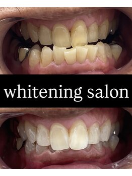 チェルト 鈴鹿店(CERTO)/歯のホワイトニング