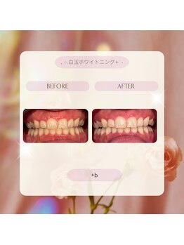 プラスビーセルフ(+b self)/ホワイトニングビフォーアフター