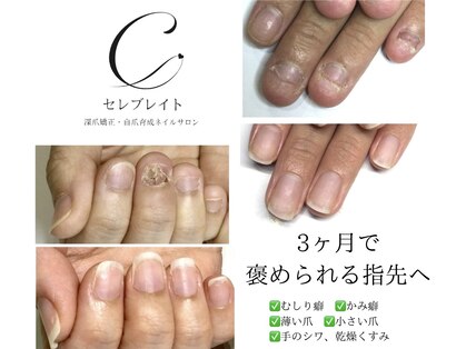 深爪矯正 ネイルケア専門サロン セレブレイトの写真