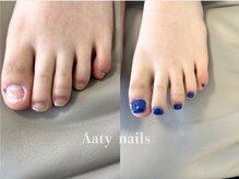アーティネイルズ(Aaty Nails)/【深爪矯正】フット