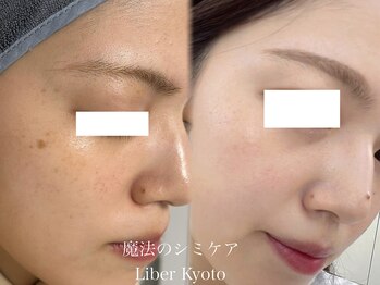 エステティック リベル キョウト 京都駅前店(Esthetic Liber Kyoto)/魔法のシミケア