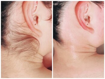 ナナイロサロン ニコリー(NaNairo nicolly)/【襟足.うなじダブル脱毛】