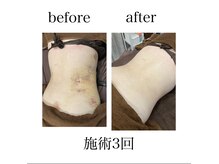 インディバケアプラチナム 横浜店/インディバ施術