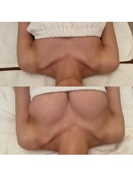 メゾン アンジュ(Maison Ange)/【バストアップ症例】バスト