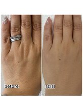 レイモード(Ray mode)/指脱毛