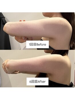 ウィール 栄 矢場町店(WE:LL)/背中&二の腕メニュー