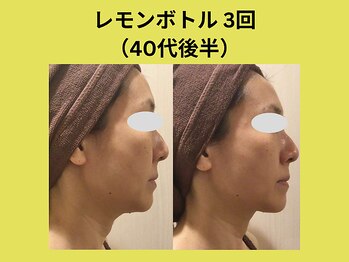 リンク 錦糸町店(Link)/レモンボトル3回