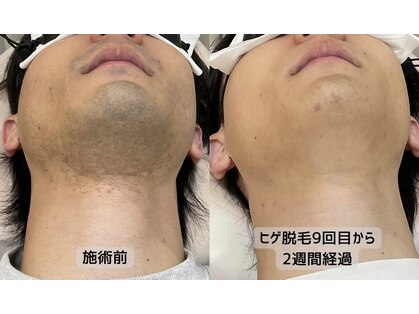 みんなのLED脱毛の写真