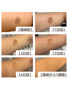 インディバケアプラチナム 横浜店/インディバ施術