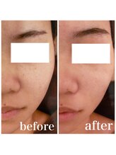 ブランシェ 金沢店 × 椿/シミケア　お客様