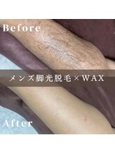 エピナ 横浜店(Epina)/メンズ脱毛/脚脱毛/足脱毛