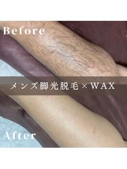 エピナ 横浜店(Epina)/メンズ脱毛/脚脱毛/足脱毛