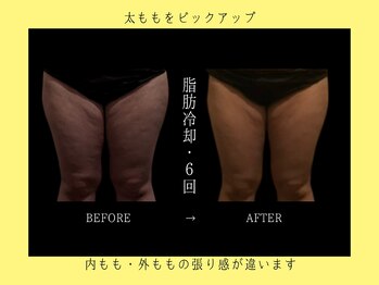 ブルースター 上小田井店(Blue Star)/脂肪冷却24カップ×6回