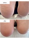 足裏角質ケア