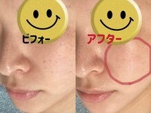 ホワイティアビシェル 浦和(Whitia Vishell)/浦和周辺シミケア専門