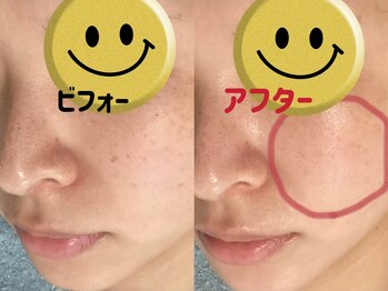 ホワイティアビシェル 浦和(Whitia Vishell)/浦和周辺シミケア専門