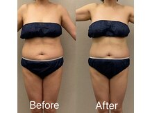 美容整体 レナトゥス 武庫之荘(Renatus)/針のいらない脂肪分解