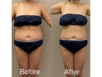 美容整体 レナトゥス 武庫之荘(Renatus)/針のいらない脂肪分解