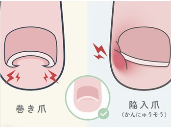 とくしま整体院 藍住院/巻き爪施術