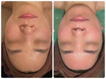 クイーンズ ピュア 長崎店(Queen's Pure)/エポレーション美容導入