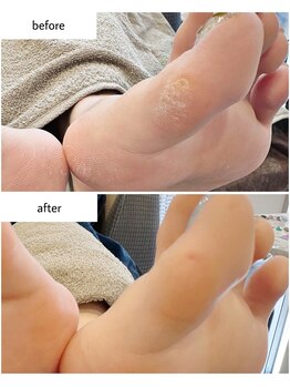 ケアプラス(care plus)/足裏角質ケア