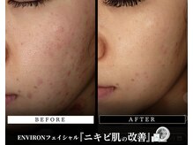 メディケア 新宿/ENVIRON フルコース【ニキビ】