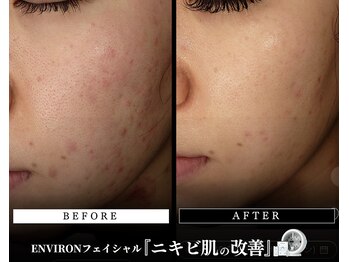 メディケア 新宿/ENVIRON フルコース【ニキビ】