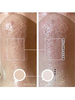 ベルーナビューティ 西新宿(Beluna beauty)/GRACE PEEL ビフォーアフター