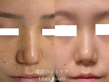 エステティック リベル キョウト 京都駅前店(Esthetic Liber Kyoto)/魔法のシミケア