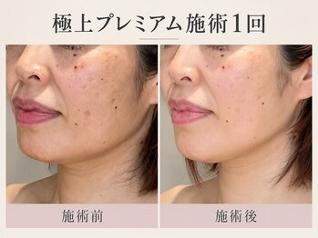 トリプルサンショップ 京都店の写真/【京都/四条】年齢とともに気になるほうれい線・たるみ・ハリ不足を丁寧に集中ケアする大人のフェイシャル