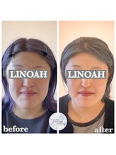 リノア 心斎橋店(LINOAH)/ウルトラプラス小顔リフト b→a