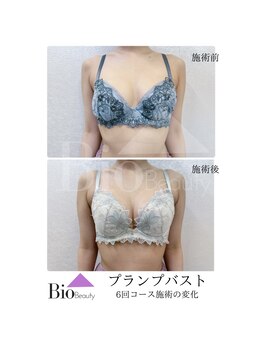 バイオビューティー 神戸本店(Bio Beauty)/プランプバスト　6回コース症例