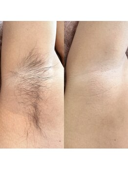 バリット 苦楽園(VALLITTO)/メンズ脱毛/ワックス脱毛/脱毛