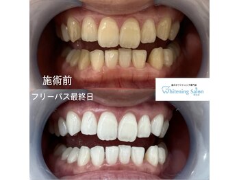 ホワイトニングサロン 熊本店/メンズもホワイトニング