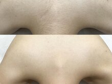 エリクサー 加須店(Elixir)/忙しいママの味方！時短脱毛◎