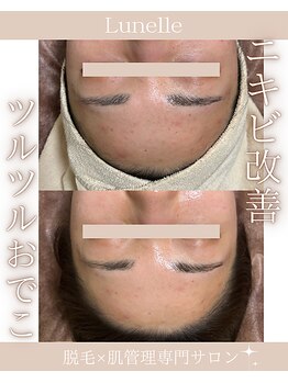 ルネル(Lunelle)/繰り返しできるおでこニキビに