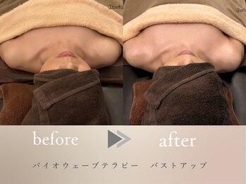 グロッシー(glossy)/【症例】電流エステ　バストUP