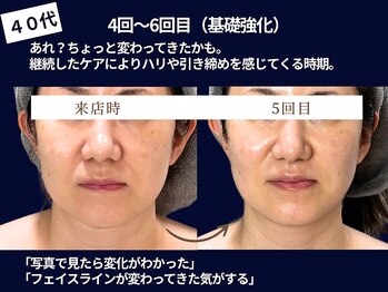 ジュジュ(juju)の写真/【当店人気!たるみ引き締め小顔リフトアップの贅沢8工程フルコース★2台の最新マシンで導く美顔造形】
