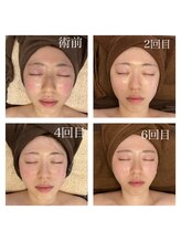インディバケアプラチナム 横浜店/インディバ≪フェイシャル≫