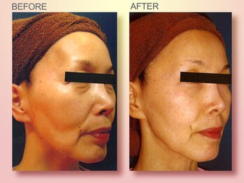 ジュリア オージェ 四条河原町店/ビフォーアフター（リフトUP)