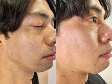 シロ(Shiro)/ヒゲ脱毛